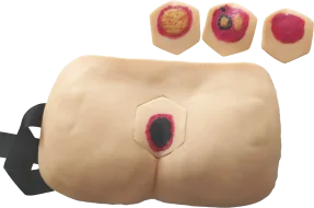 Advanced Pressure Ulcer ( Pressure Sore ) Nursing Model