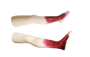 Advanced Chronic Leg Ulcer Diagnosis Training Model