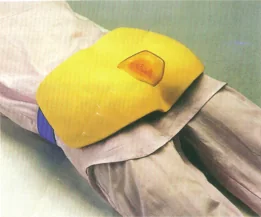 Pressure Sore Nursing Model